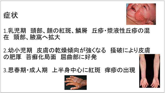Figure.3 Symptoms of Atopic Dermatitis<